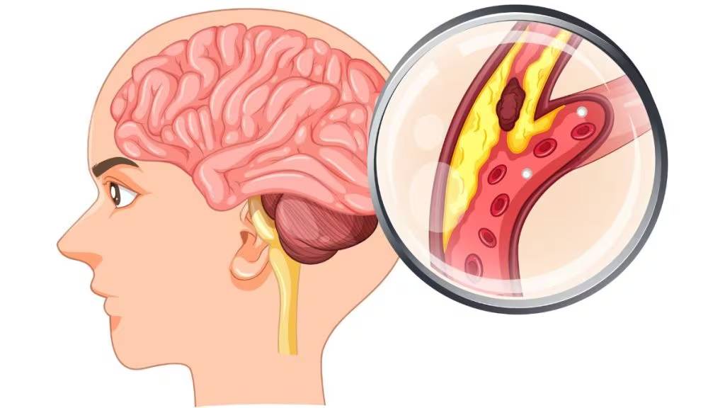 Deadly brain-eating amoeba cases rising in Kerala: Doctors share warning signs and prevention tips
